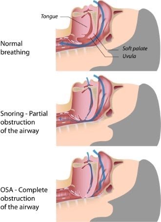 Infographic showing the airways closing during obstructive sleep apnea OSA