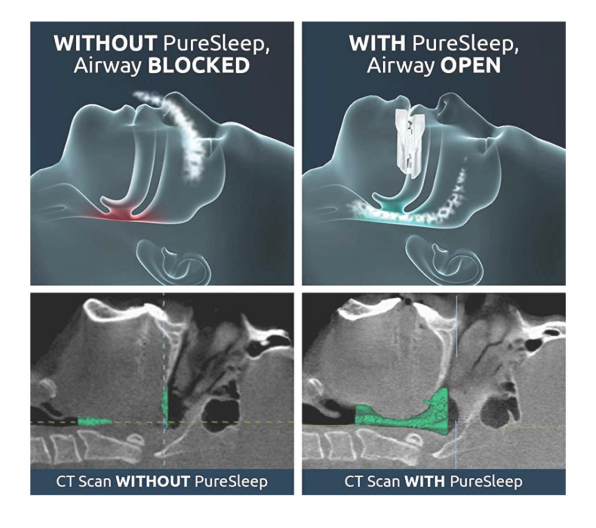 How the pure sleep mouthguard works to improve snoring and sleep apnea