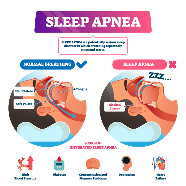 Snoring and sleep apnea infographic block airway info 